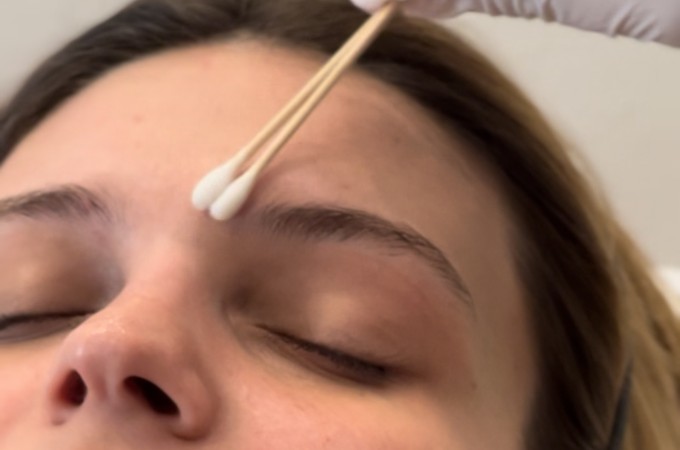 PicoPeel - Peeling